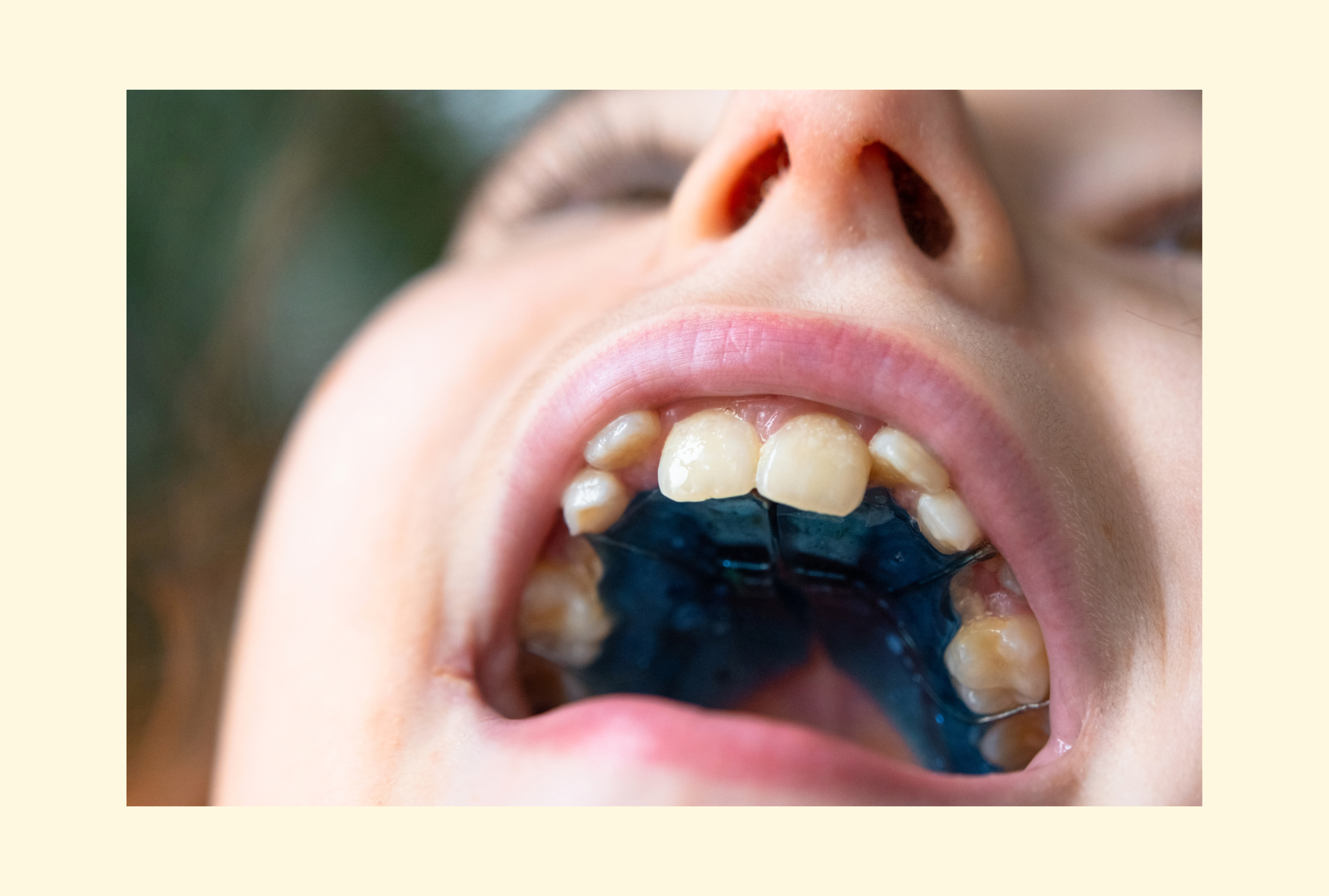 小児矯正のイメージ