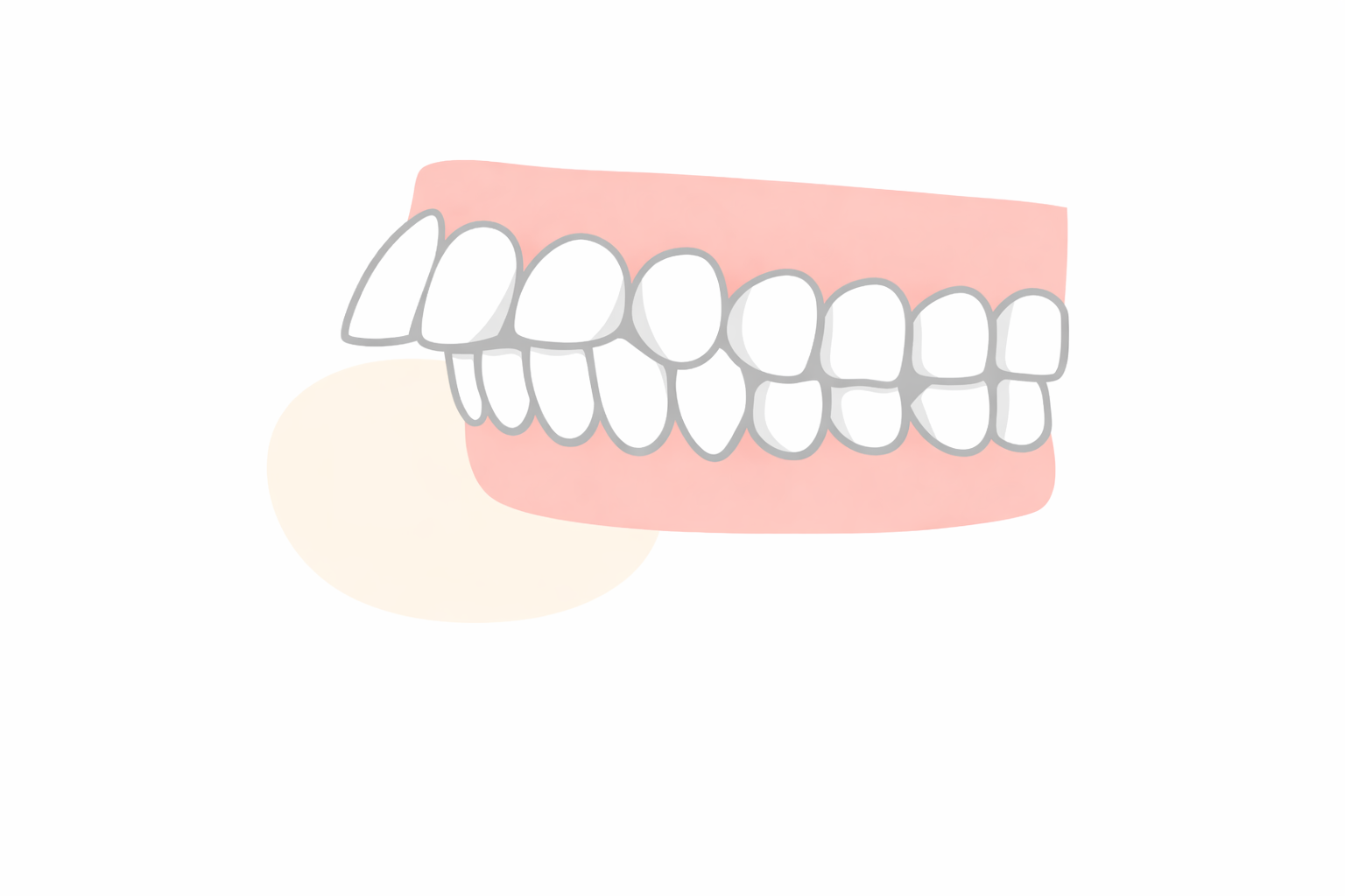 出っ歯（上顎前突）のイラスト