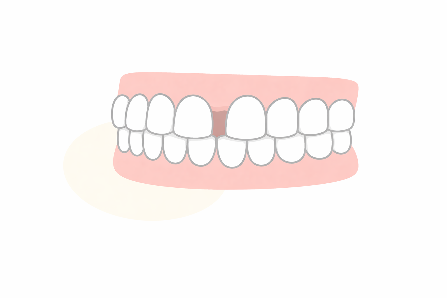 すきっ歯（正中離開・空隙歯列）のイラスト