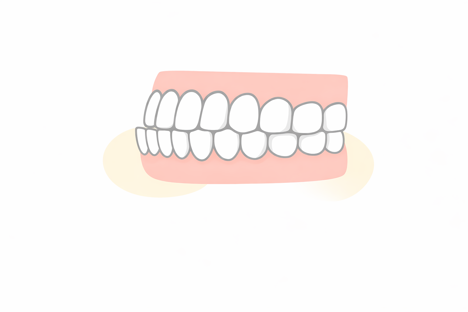 受け口（下顎前突）のイラスト